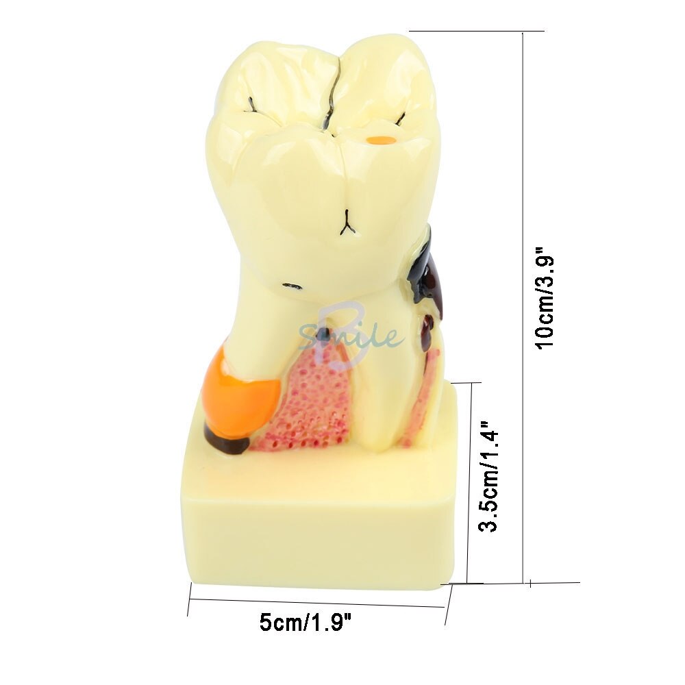 1pcs Dental Tooth Neuroanatomy Teaching Model 4 times transparent molar profile model with nerve Pathological Tooth Model