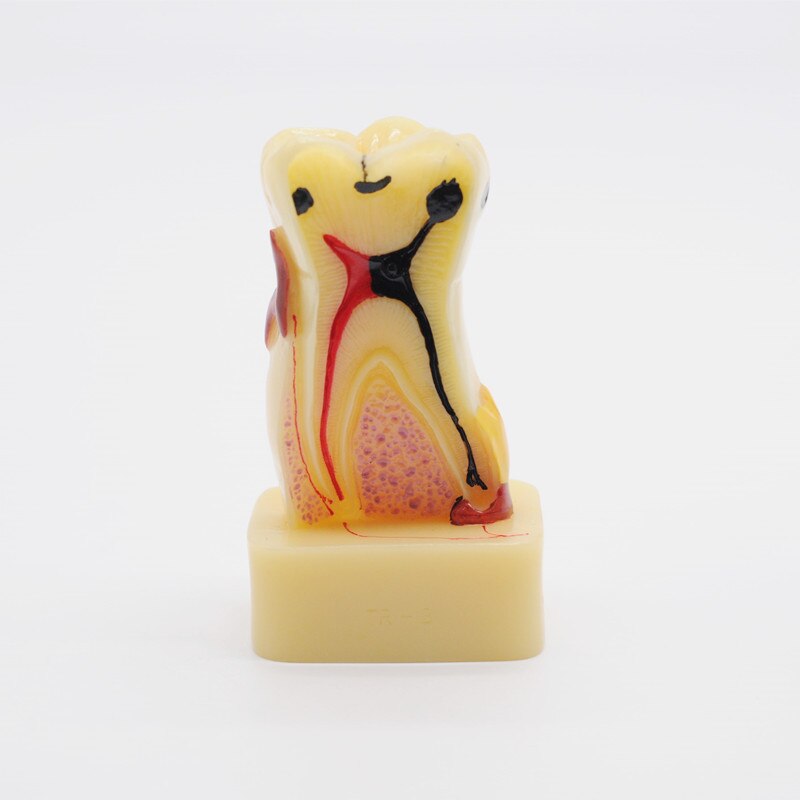 1pc Teeth Model 4 Times Tooth Pathology Model Comprehensive Periodontal Models for Dental Teaching Study Model