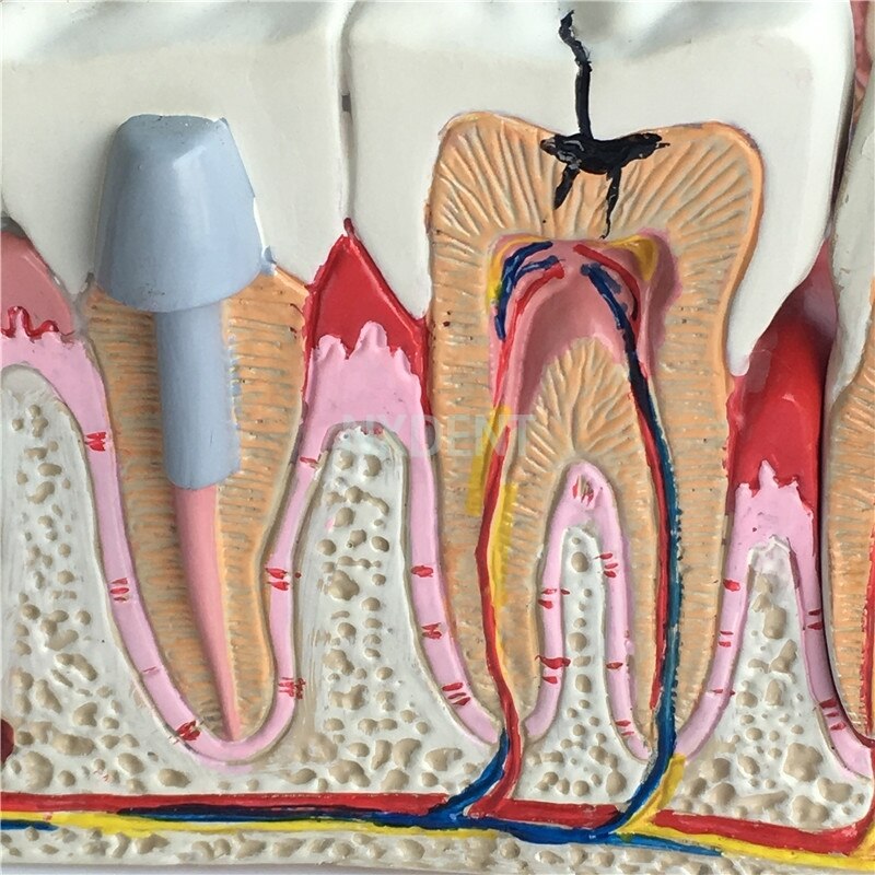 1 Stuks Dental Anatomische Tand Tanden Model Anatomie Tanden Model Oversized Anatomie Rotte Tand Demonstratie Communicatie