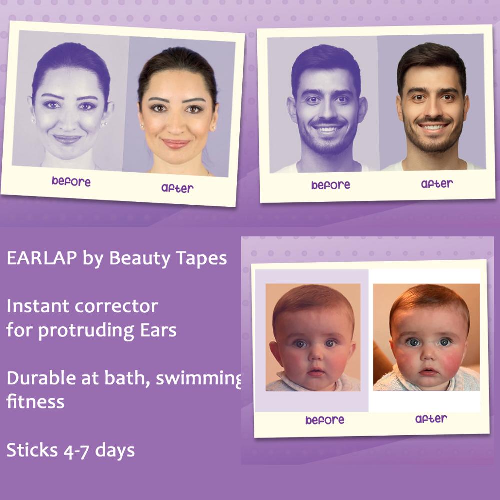 EARLAP Ear Corrector Tapes for Protruding Ears . Suitable for newborns and adults. Otostick. Arrilis Best Ear Corrector