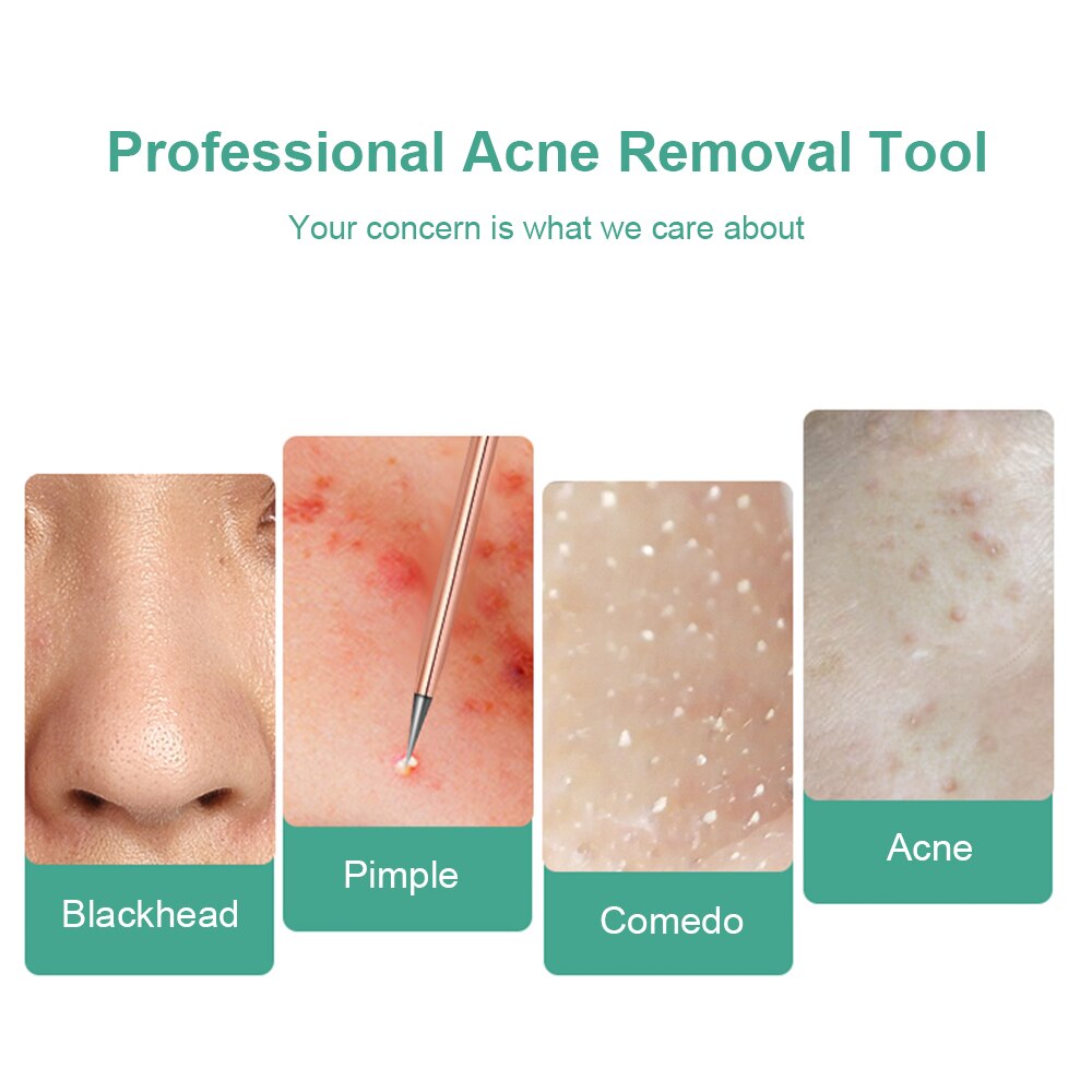 4pcs/set Blackhead Removal Needles Tool Kit Acne Clip Blemish Squeeze Pimple Acne Extractor Black Head Pore Cleansing Tool