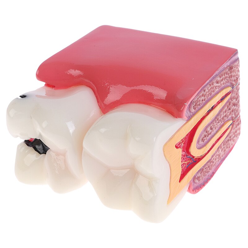 Dental Teeth Model 6 Times Caries Comparation Study Denture Tooth Models
