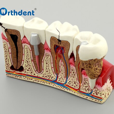 Dental Model Dental Pathology Model Grandado