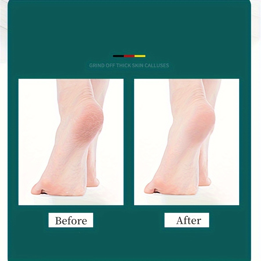 Voet Bestand Dubbelzijdig Eelt Remover Voor Dode Huid Professionele Pedicure Gereedschap Eelt Schraper Sander Hak Filer