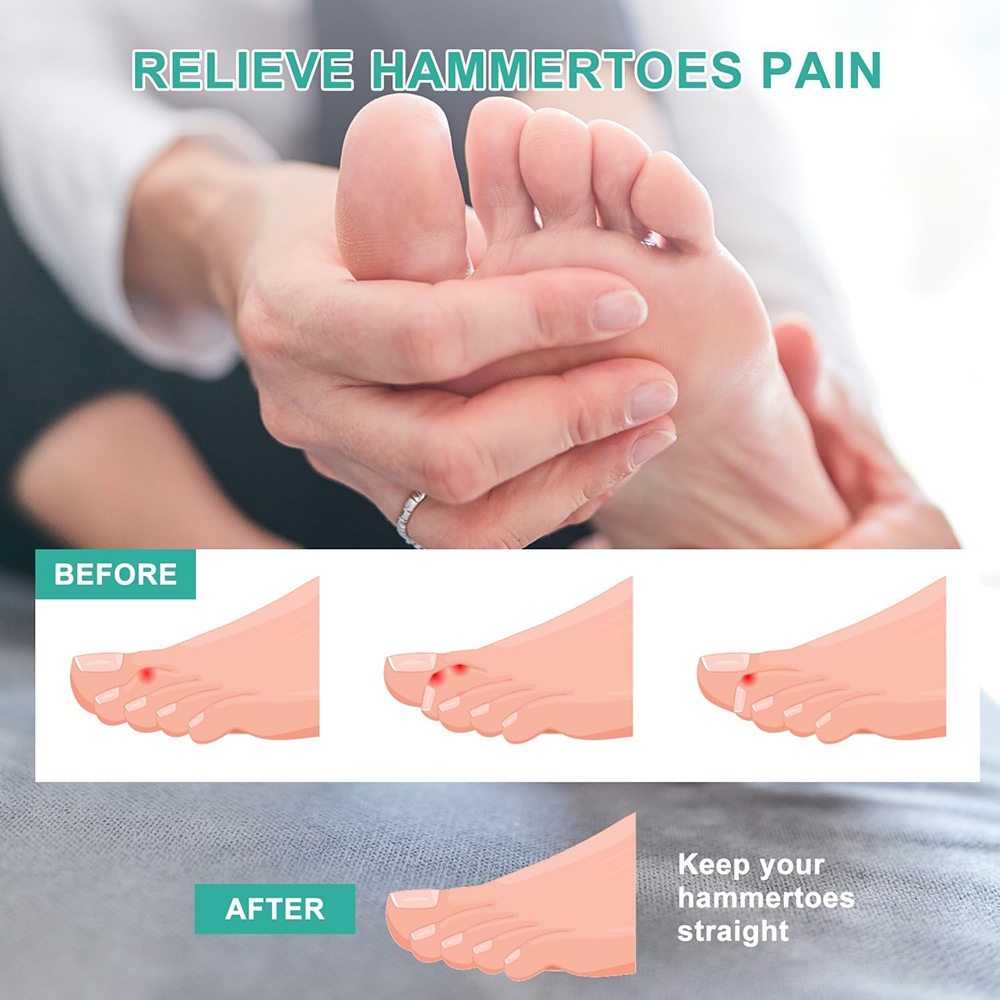 Pexmen 2/4/10 Stuks Hamerteen Stijltang Hamerteen Corrector Voor Gekruld Krom Gebogen En Klauw Tenen Stoppen Teenoverlapping En Wrijven