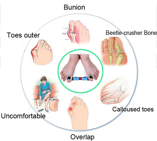 Massage Hallux Valgus Orthesen Bigtoe Brancard Corrector Massage Bone Duim Training Corretivo Massage Spalk CorrectionZ31501