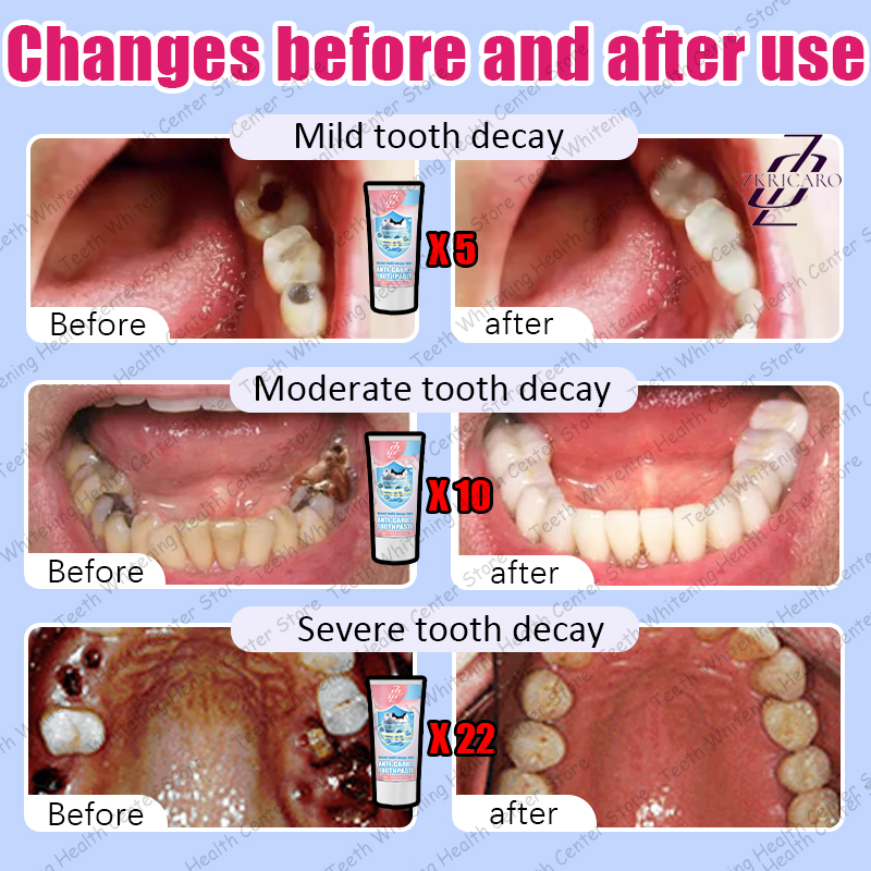 Latest Teeth Cleaning to Eliminate Tooth Decay