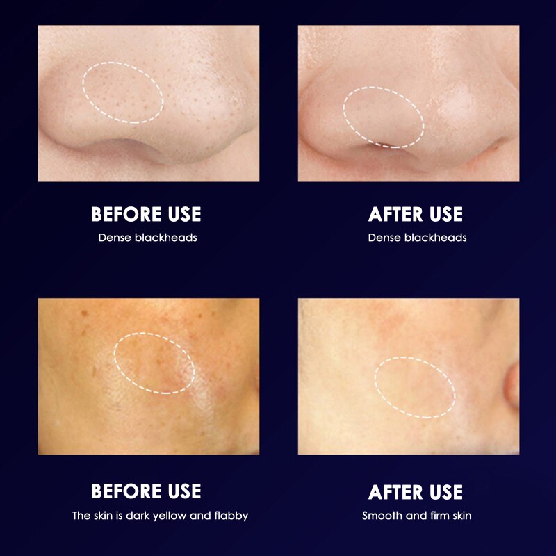 Shoveling Machine CleanserSkin Scraper Blackhead Removal Pore Cleanser Facial Scraper Acne Extractor Facial Lift Deep Cleansing