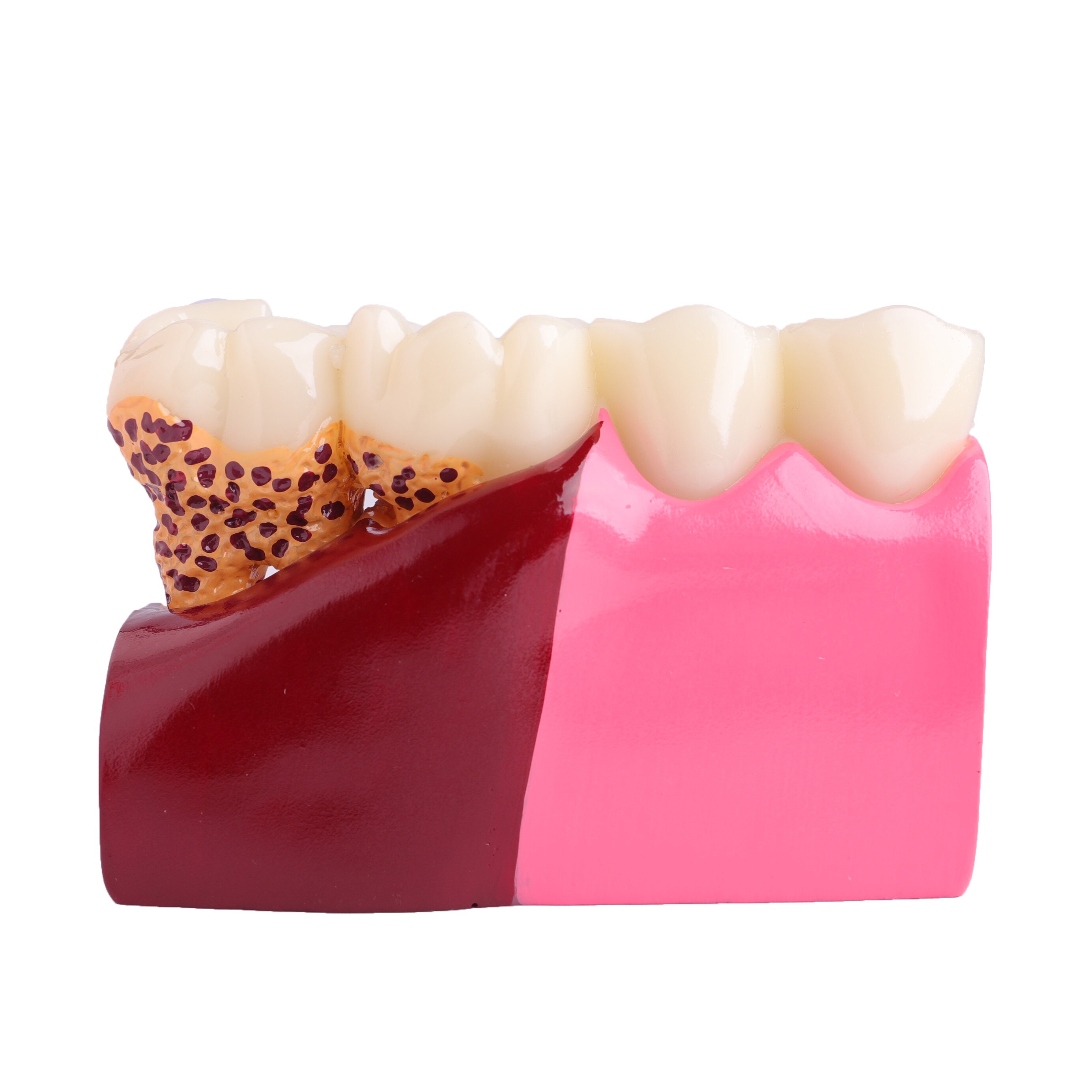 Dental Anatomy of Dental Caries Teeth Model Demonstration M4029 Planting Pathological Display Model
