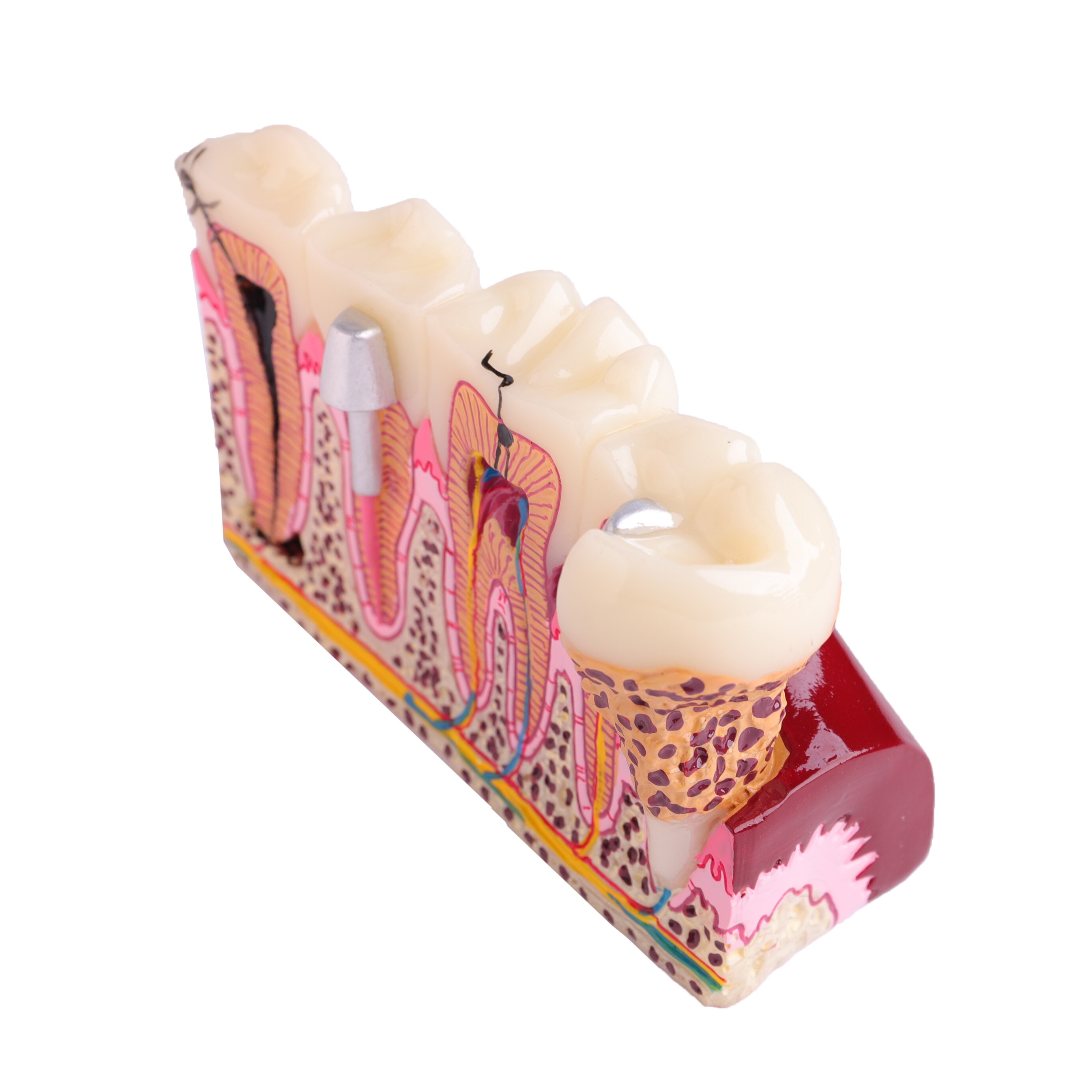 Dental Anatomy of Dental Caries Teeth Model Demonstration M4029 Planting Pathological Display Model