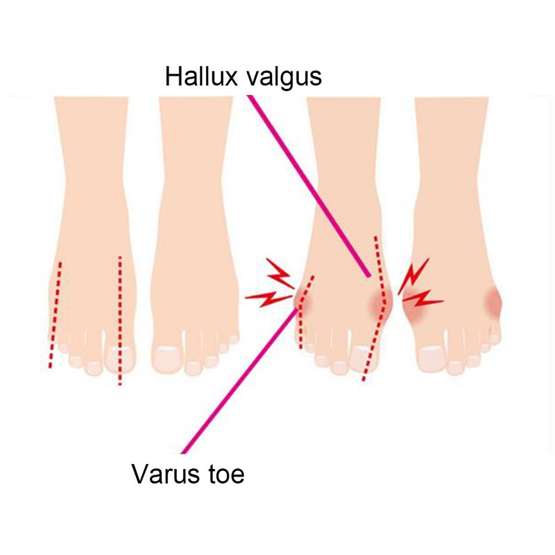 1 paire pédicure orteil séparateur Hallux Valgusbones chevauchement orthèse de Correction des orteils semelles correctrices séparées orteils entretoise
