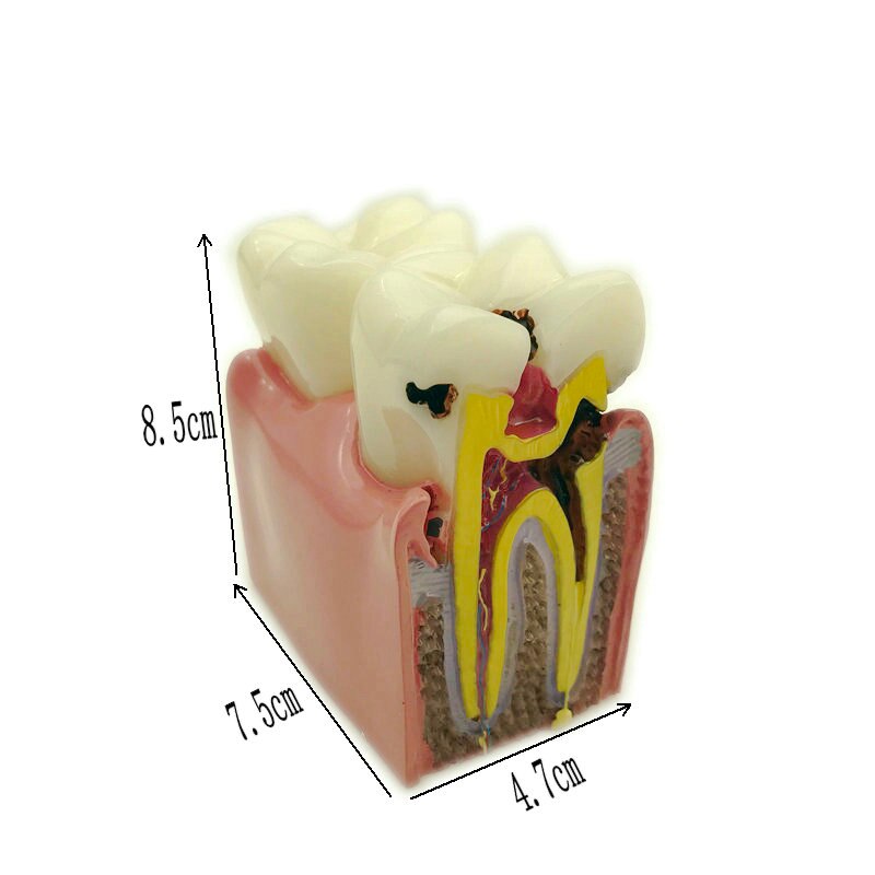 1pc Dental Anatomy Education Teeth Model 6 Times Caries Comparation Study Models For Dentist Studying and Researching