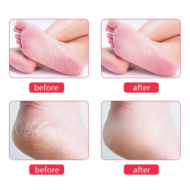 2/1pcs Pedicure Foot Care Tools Double Side Foot Rasp File Dead Skin Callus Remover File Exfoliating Pedicure Foot File Skin Ca