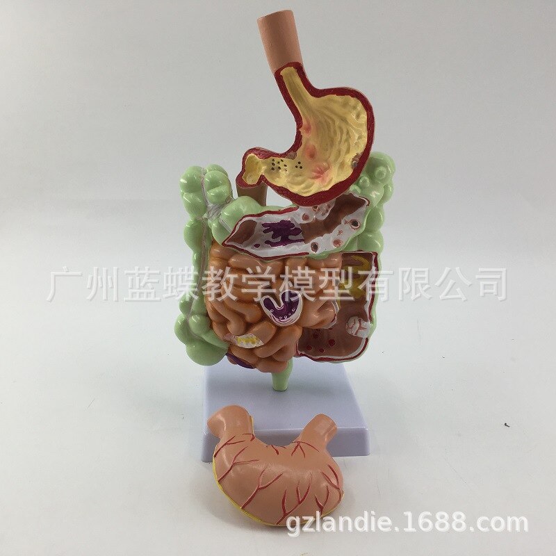 Pathological model of large intestine stomach model of large intestine disease model of human colon disease