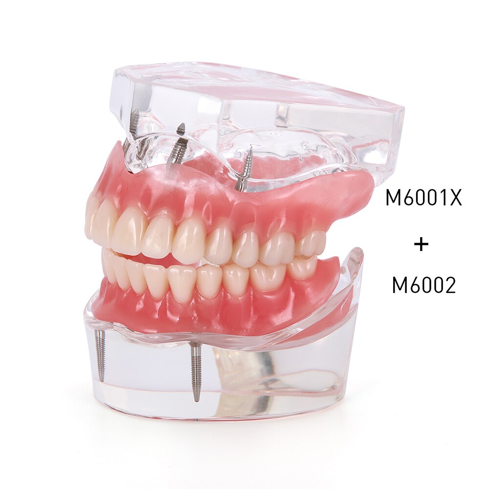 Tannimplantat restaurering tenner modell flyttbar bro protese demo sykdom tenner modell med restaurering bro undervisning studie