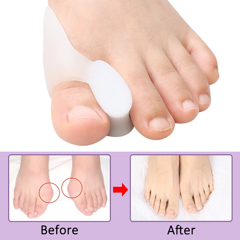 Pexmen 2 Teile/para Gel Zehe Separator Ballen Knochen Ektropium Erzähler Zehen Außen Gerät Fuß Pflege Werkzeuge Hallux Valgus Korrektor