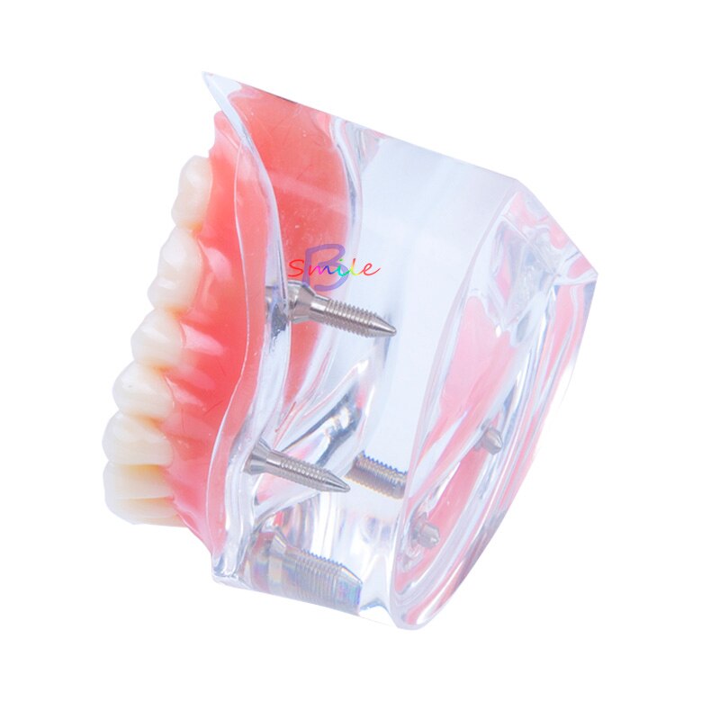 1pcs Dental Teaching Study Overdenture Teeth Model Removable Interior Mandibular Lower Teeth Model tool