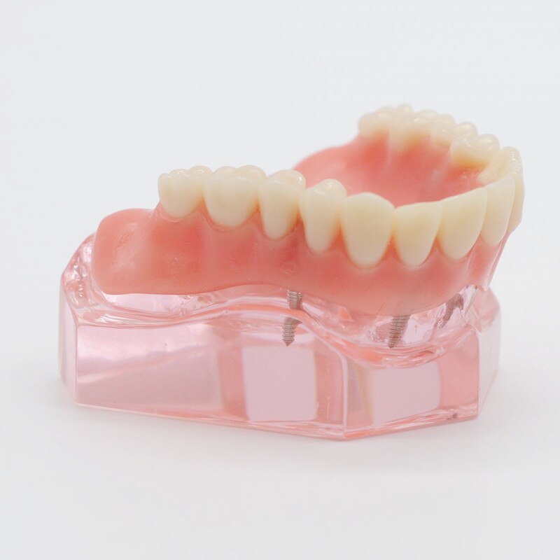 Zahn Zähne Modell Overdenture Oberen Vorderseite Oberkieferzähne 4 Implantate Restaurierung Zahnarzt Artikel Zahnersatz Zahn Extraktion
