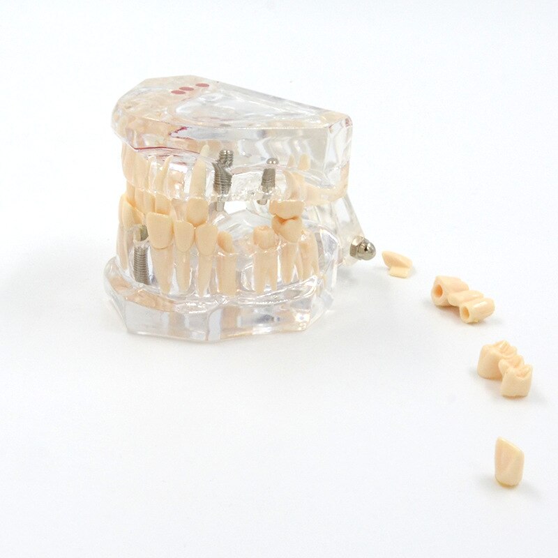 Supply Dental Model Transparante Pathologische Reparatie Menselijk Tandheelkundige Model