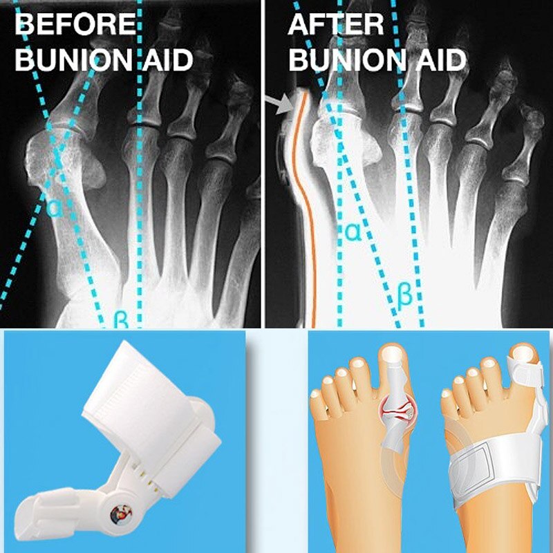 Toe Separator Feet Care Toe Separators Stretchers Foot Pads Enhanced Hallux Valgus Orthopedic Adjust Big Toe Pain Relief -35