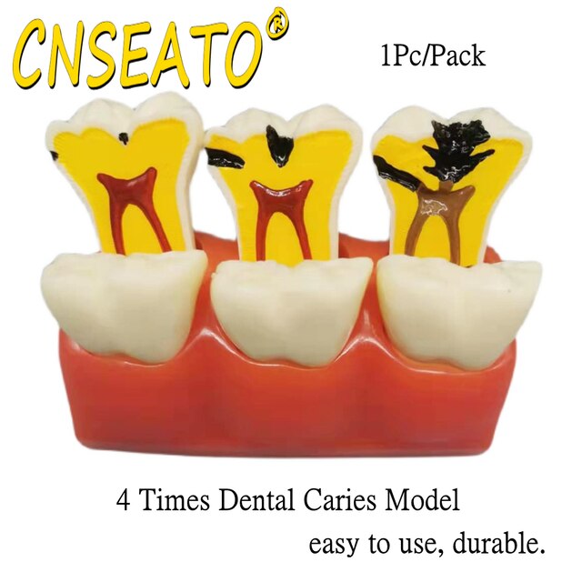 Dental Caries Tooth Model Removable Dentures 4 Tim... – Vicedeal