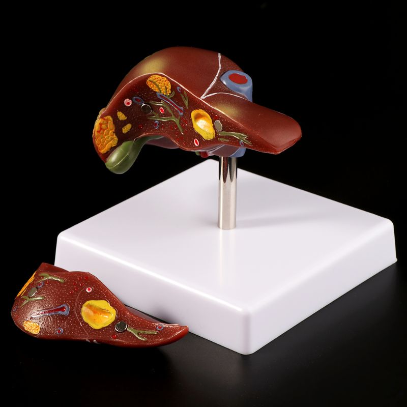 Modelo anatómico patológico del hígado humano, herramienta de exhibición para enseñanza escolar de anatomía, equipo de laboratorio L29K