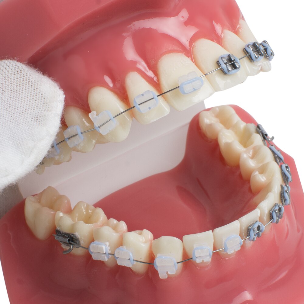 Dental Tanden Studie Orthodontische Rode Model met Metalen en Keramische Brackets Orale Demonstreren Modellen