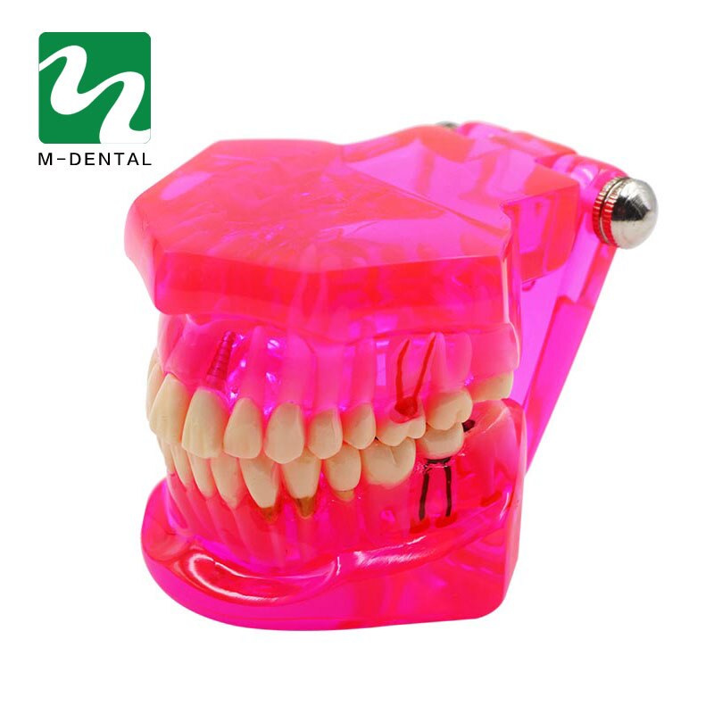 Modelo de dientes de estudio Dental desmontable para adultos, modelo de dientes de enseñanza patológica, rojo transparente, 1 unidad