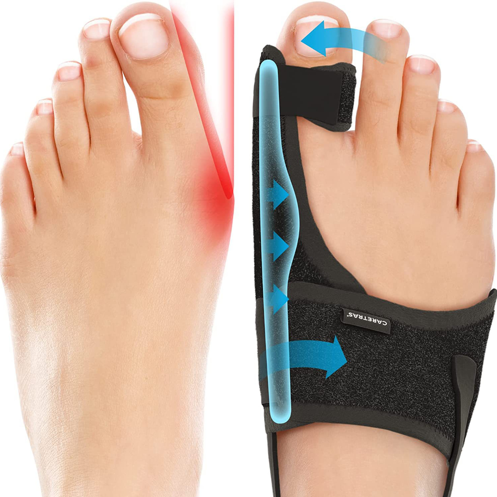 Ortopedisk hallux valgus-korreksjon, stortåseparator, smertelindring, ikke-kirurgisk hallux valgus-korreksjon, hammertårettingsverktøy