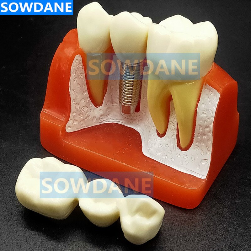 4 keer Dental Implant Ziekte Analyze met Restauratie Crown Bridge Demonstratie Dental Tanden Model Onderwijs studie M