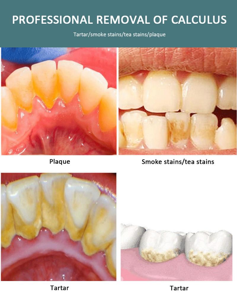 Bärbar elektrisk sonic dental scaler tand tandstensborttagningsmedel fläckar tandsten plack whitening munrengörare maskin munhygien