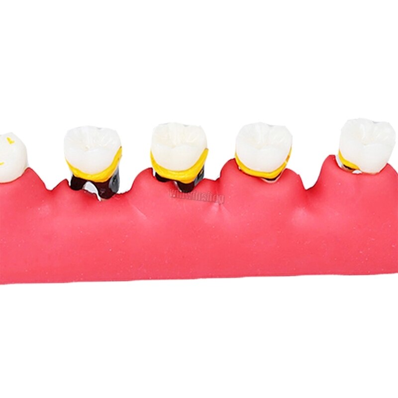 Dental Periodontal Disease Classification Model Demonstration Teach Study Decayed tooth Show Periodontal Disease Progress Model