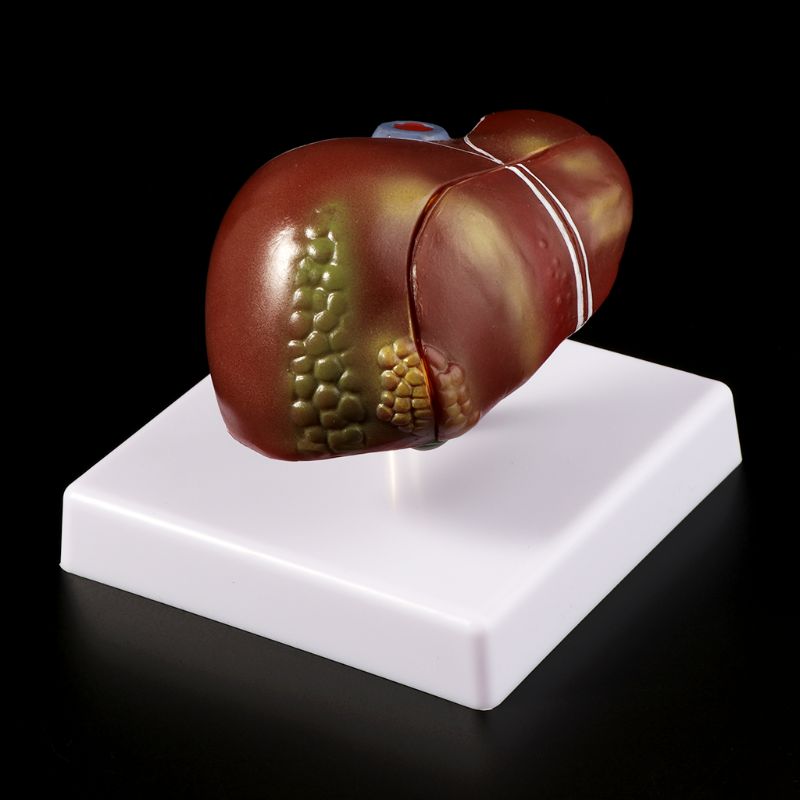Modelo anatómico patológico del hígado humano, herramienta de exhibición para enseñanza escolar de anatomía, equipo de laboratorio L29K