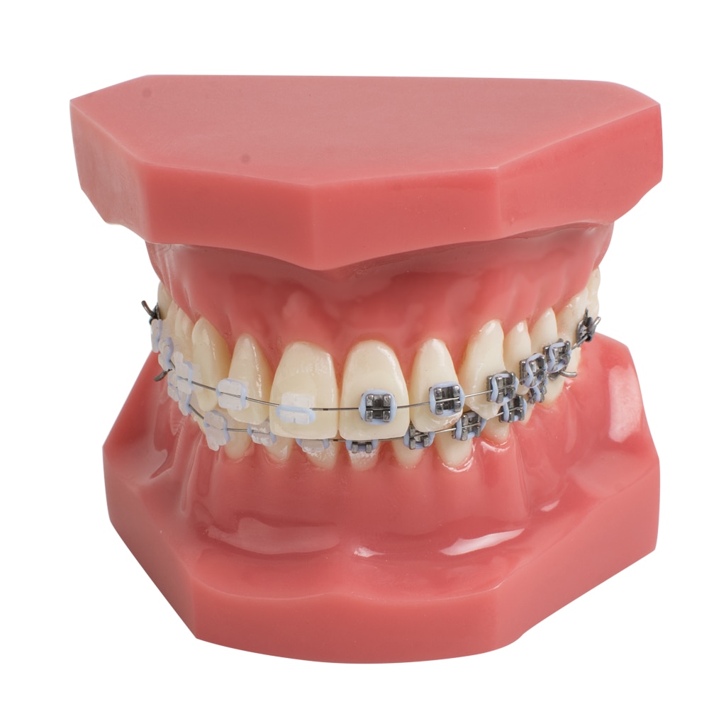Dental Tanden Studie Orthodontische Rode Model met Metalen en Keramische Brackets Orale Demonstreren Modellen