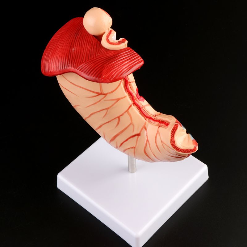 Human Anatomical Anatomy Stomach Model Gastric Pathology Gastritis Ulcer Teaching Learning Tool U4LD
