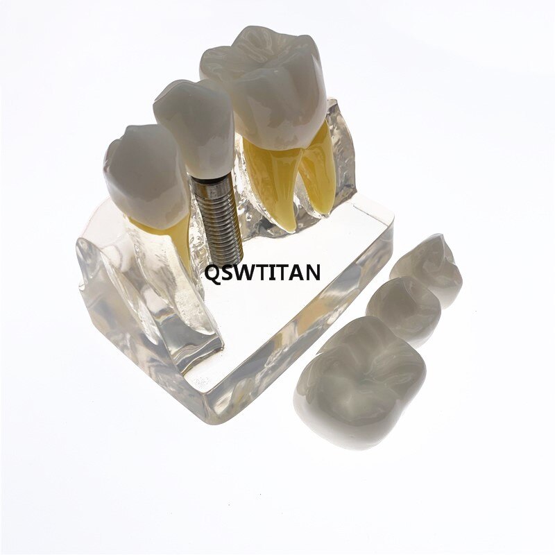 Clear Dental Demonstration Study Teeth Model for Implant Analysis Crown Bridge Model