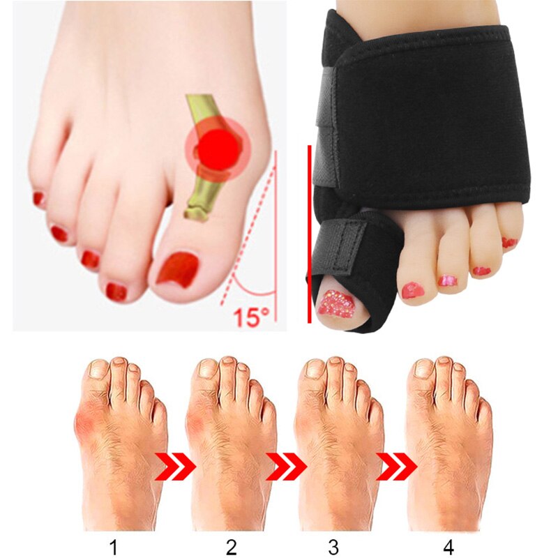 1 Paar Bretels Teenseparators Spalk Apparaten Hallux Valgus Voetverzorging Pedicure Bretels