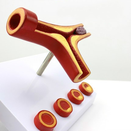 10X Enlarge Human Arterial Coronary Arteriosclerosis Atherosclerosis Coronary Model Cross Section Heart Disease Thrombus Model