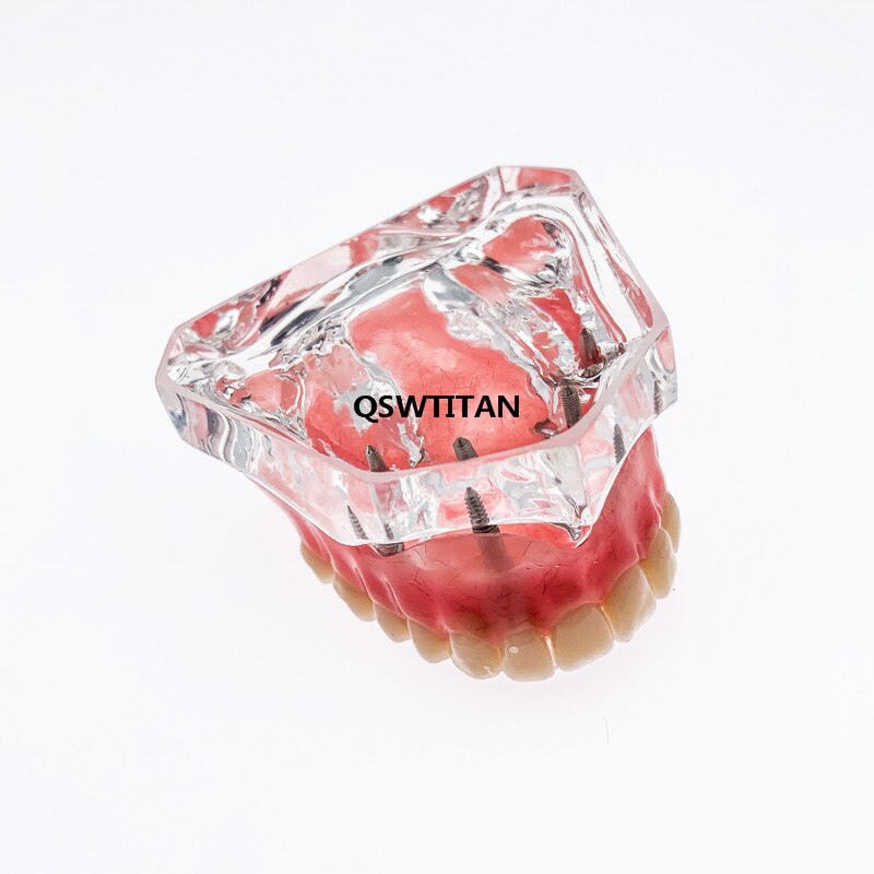 Sobredentadura Dental Superior con 4 implantes, modelo de demostración, enseñanza Dental, estudio, modelo de dientes: Transparent 4Implant