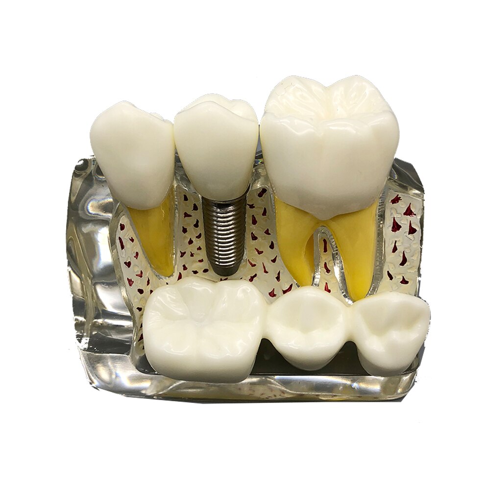 4 Times Dental Implant Analysis Crown Bridge Demonstration M2017T Dental Teeth Model Dentist Patience Model