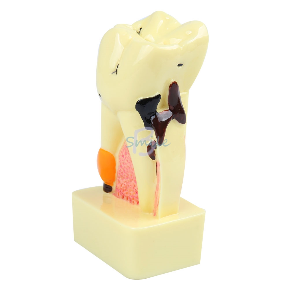 1pcs Dental Tooth Neuroanatomy Teaching Model 4 times transparent molar profile model with nerve Pathological Tooth Model