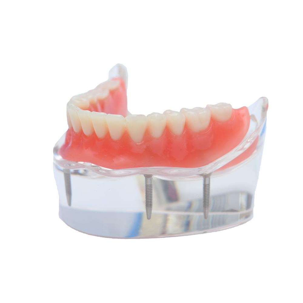 Dental Implant Teeth Teaching Model Overdenture Restoration Clear Removable Interior Maxillary Mandibular Tooth Demonstration