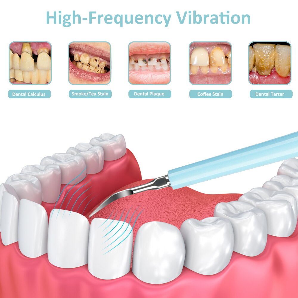 Elektrische Ultra Schall- Schall- Zahn Scaler Zahn Zahnstein Entferner Reiniger Hohe Frequenz Zahn Flecken Zahnstein Werkzeug Bleichen Zähne Neue