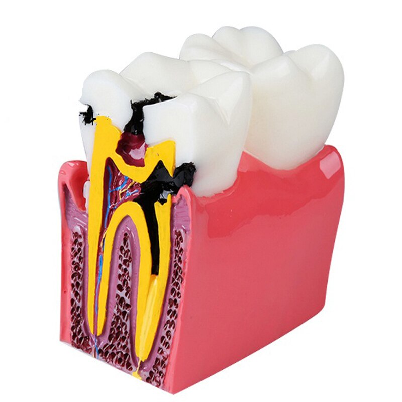 6Ttimes Cariës Comparation Tanden Model M4021 Tonen Normale Anatomische Oppervlak Van De Tand/Dental Onderwijs Model M4021