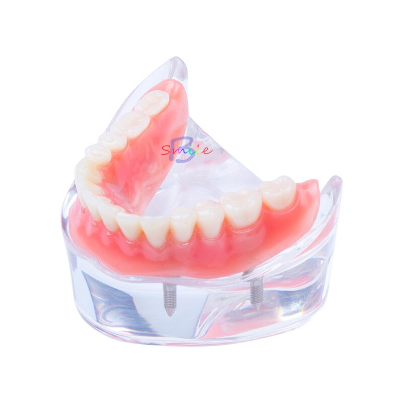 1pcs Dental Teaching Study Overdenture Teeth Model Removable Interior Mandibular Lower Teeth Model tool