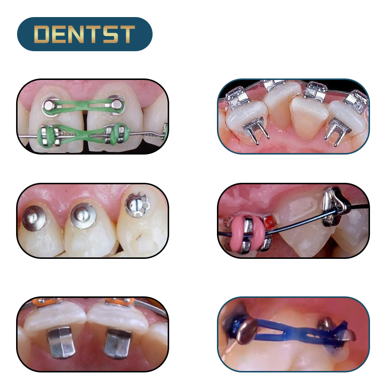 Dentst 50 pièces orthodontie dentaire liaison directe oeillet céramique bouton lingual langue dompteur morsure ouvre-crochet de Traction crochet à sertir