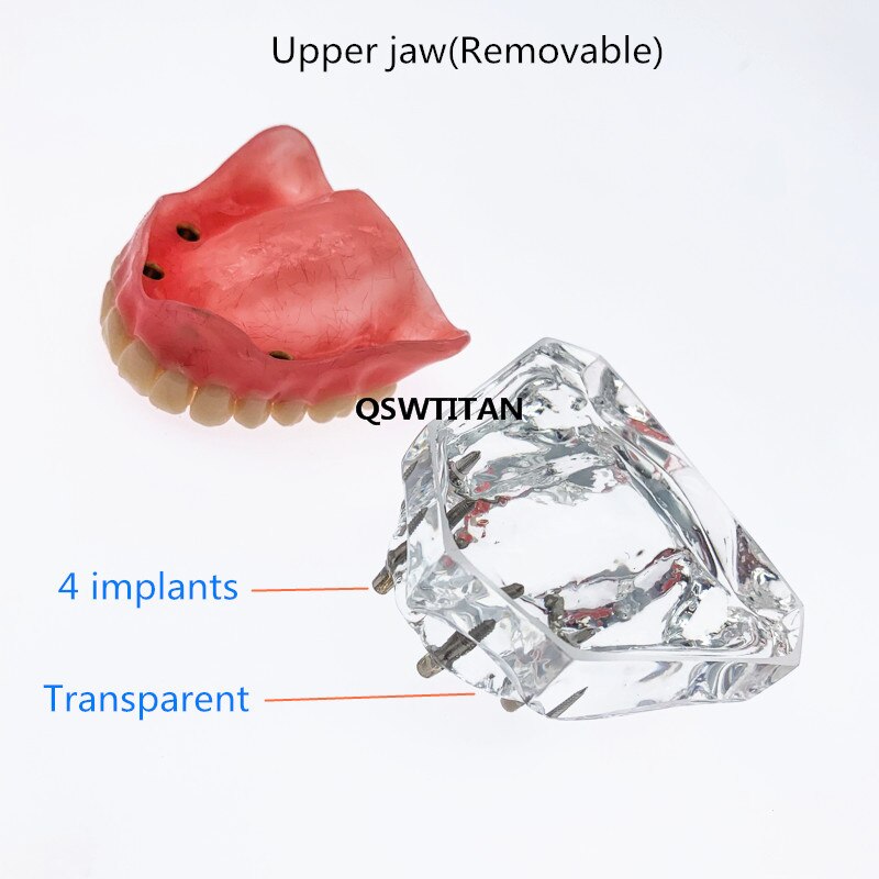 Sobredentadura Dental Superior con 4 implantes, modelo de demostración, enseñanza Dental, estudio, modelo de dientes