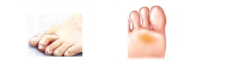 1Pcs Hammer toe corrector foot care prevent callus orthotics toes cushion pads Straightening belt relieve pain correction Z19001