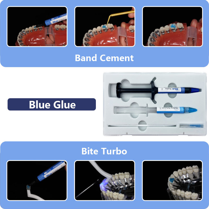 Adhesivo de ortodoncia Dental, Kit de pegamento de curado automático/ligero para soportes de ortodoncia, pegamento azul, sistema de unión directa de odontología