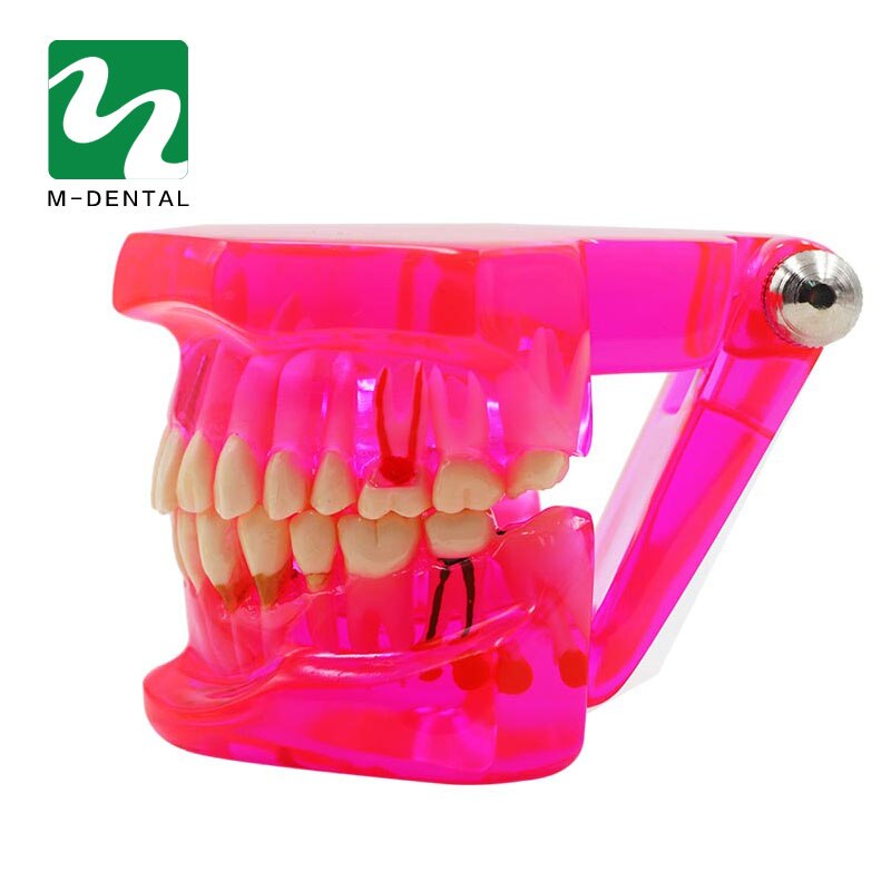 Modelo de dientes de estudio Dental desmontable para adultos, modelo de dientes de enseñanza patológica, rojo transparente, 1 unidad